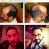 A.J. McLean reveals hair transplant