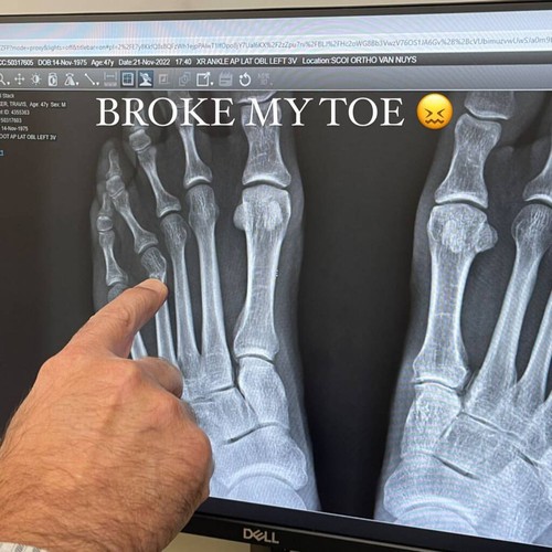 Travis Barker suffers broken toe